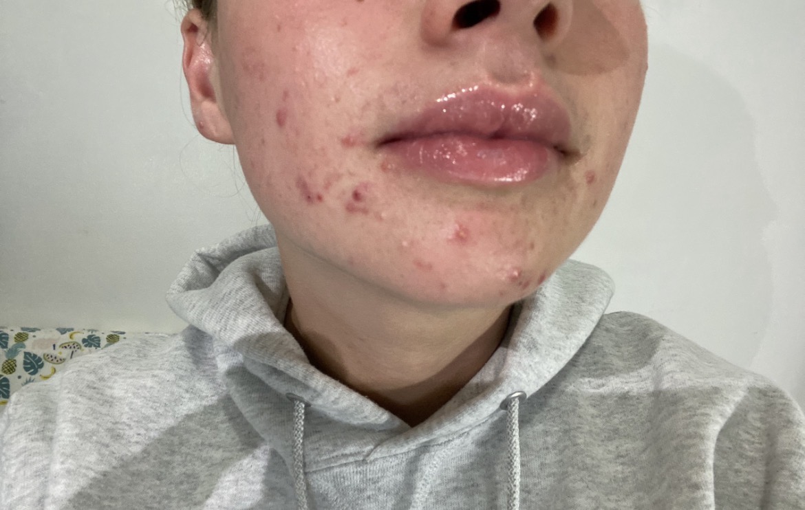 Photos of acne to show progress