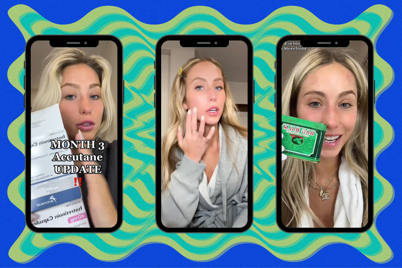 Alix Earle Acne Accutane