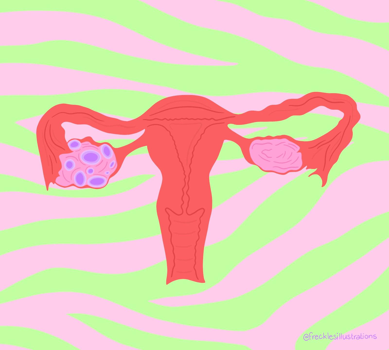 pcosjpg by frecklesillustrations?width=698&height=466&fit=crop&auto=webp&dpr=4