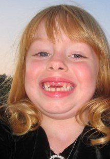 2005 no front teeth