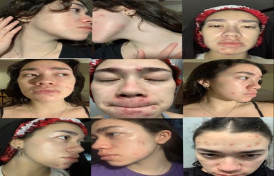 several up close images of woman with acne
