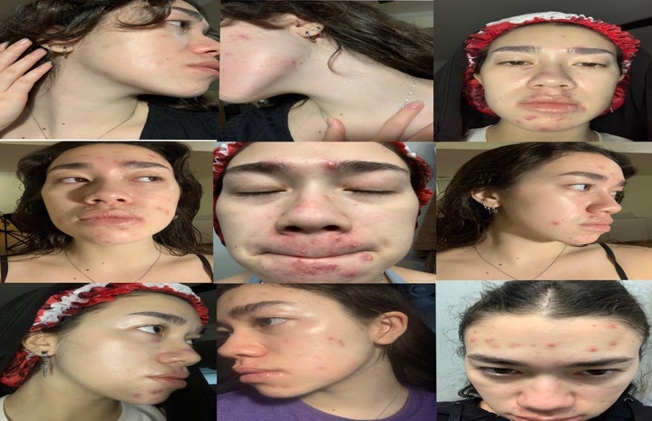 several up close images of woman with acne