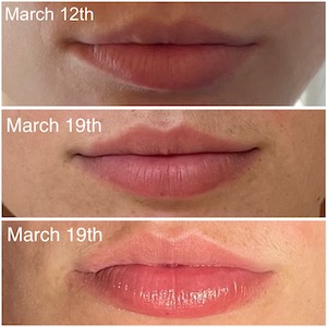 hyaluronic acid lips resumission